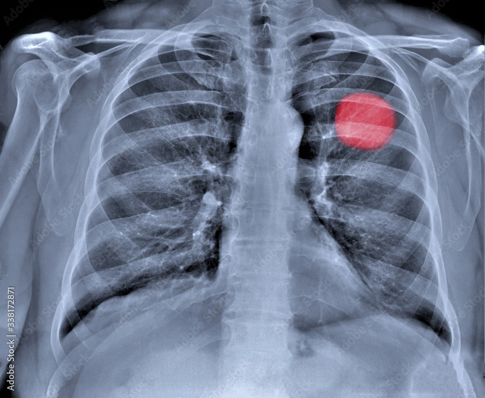 chest x-ray with pneumonia from coronavirus chest x-ray with pneumonia from coronavirus