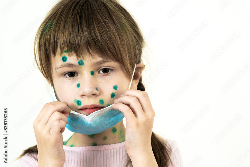 Child girl wearing blue protective medical mask ill with chickenpox, measles or rubella virus with rashes on body. Children protection during epidemic of coronovirus. Covid-19 contagion concept. Child girl wearing blue protective medical mask ill with chickenpox, measles or rubella virus with rashes on body. Children protection during epidemic of coronovirus. Covid-19 contagion concept.