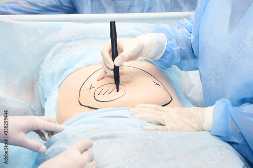 Surgery room. Belly surgery. Doctor mark liposuction area at tummy. Drawing at skin. Anti cellulite equipment. Copy space. Light blue color. Fat abdomen. Hostipal doctor hands photo