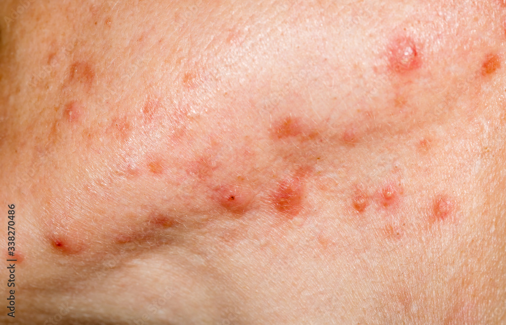 Fototapeta premium Nodulocystic acne on human skin