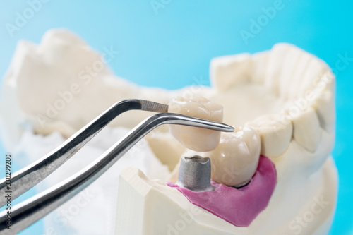 Closeup / Implant Prosthodontics or Prosthetic / Tooth crown and bridge implant dentistry equipment and model express fix restoration.