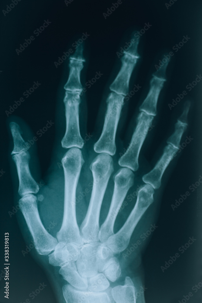 X-ray of the hands. Real x-ray picture of a hand with fingers. At the doctor’s appointment, hospital. X-ray of the hands. Real x-ray picture of a hand with fingers. At the doctor’s appointment, hospital.