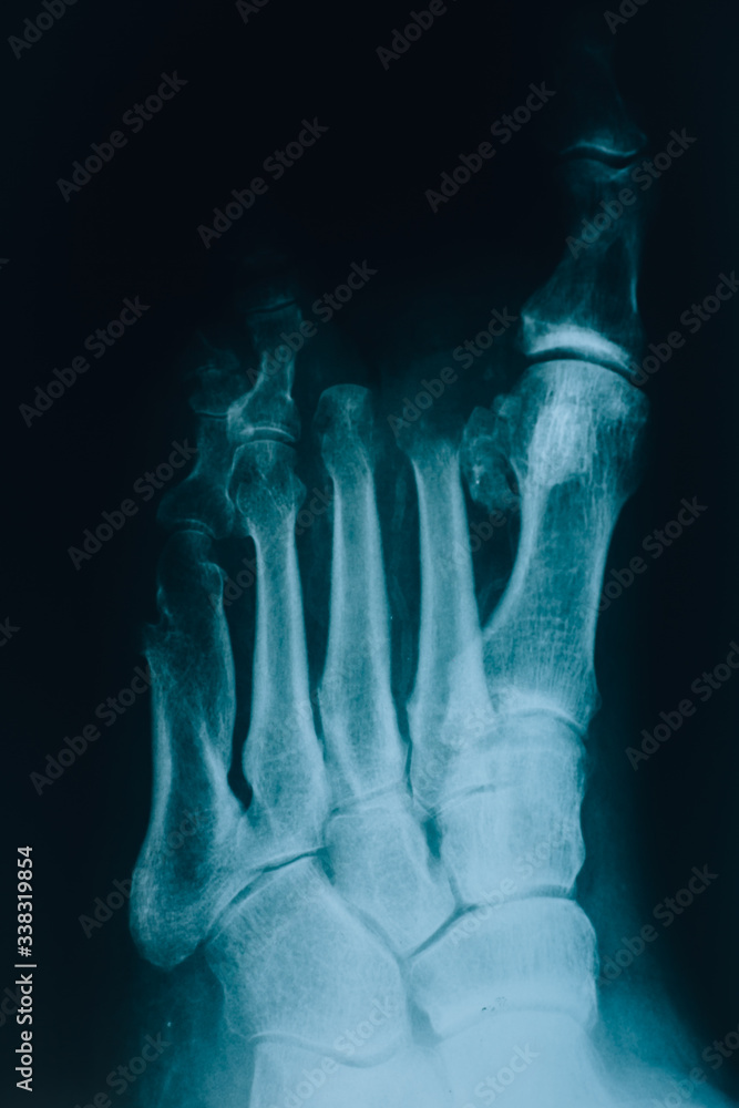 X-ray of the foot. A real x-ray picture of a sore foot. At the doctor’s appointment, hospital. X-ray of the foot. A real x-ray picture of a sore foot. At the doctor’s appointment, hospital.