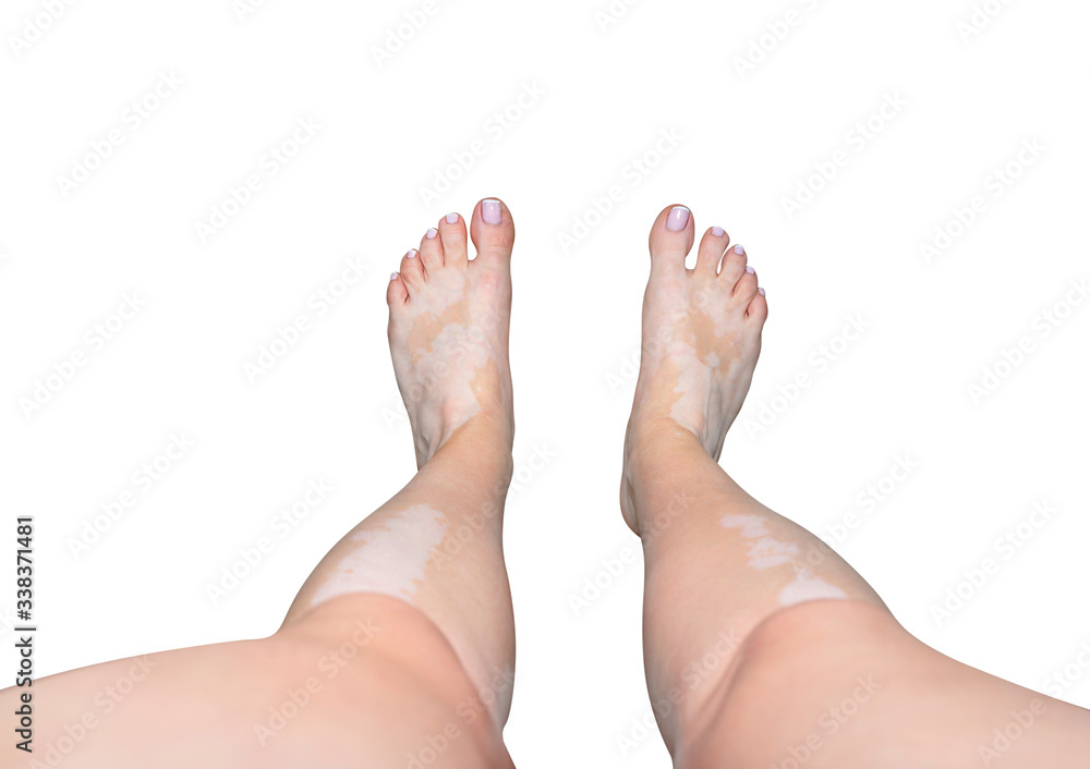 Obraz premium Stains from vitiligo disease on a legs and foots in a young Caucasian woman, isolated on a white background with a clipping path. 