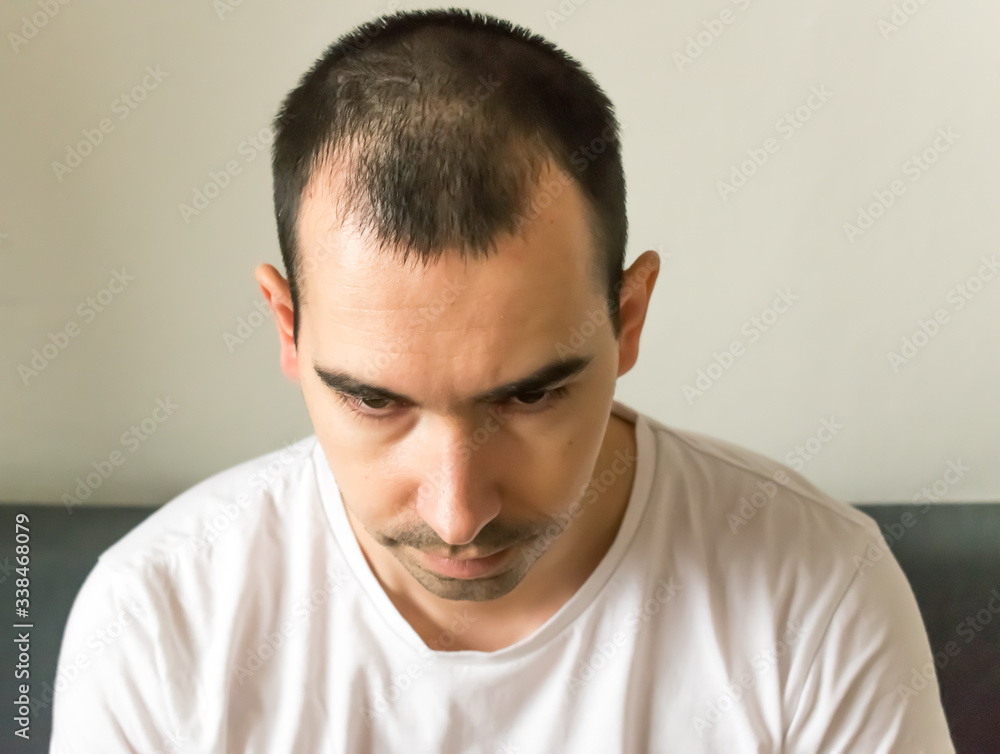 Obraz premium hair loss symptoms and causes, man model sit black hair young closeup hair loss sad