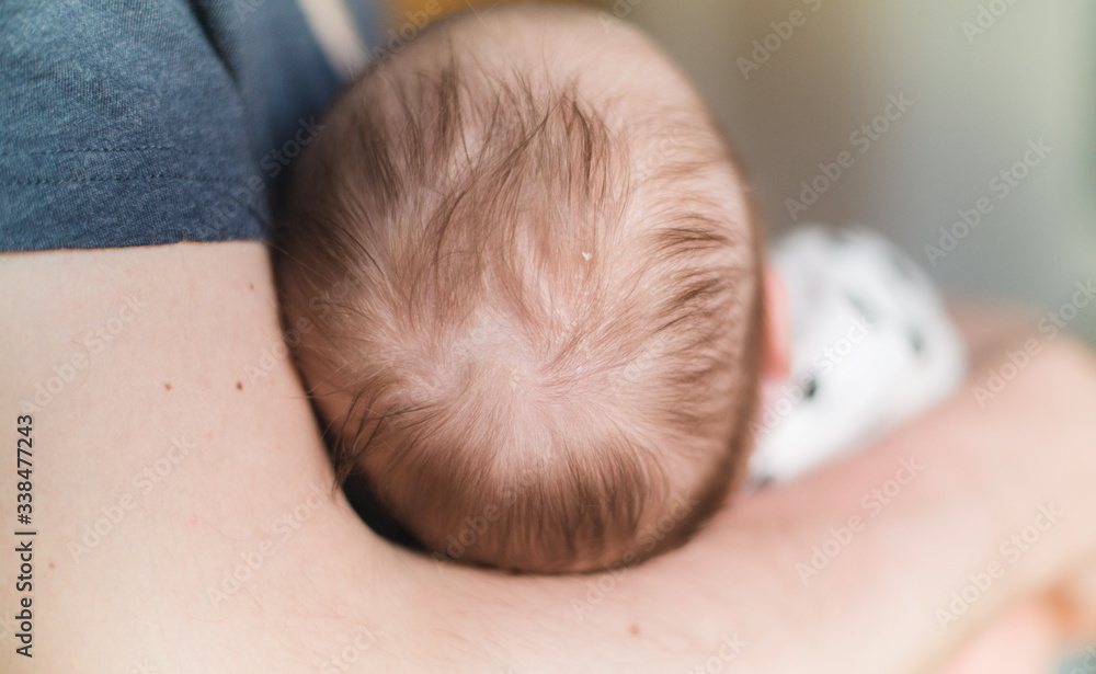 A father holiding a Newborn , close up on a head (scalp) with cradle cap (infantile seborrheic dermatitis) A father holiding a Newborn , close up on a head (scalp) with cradle cap (infantile seborrheic dermatitis)
