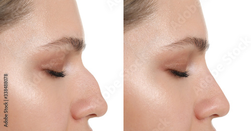 Woman before and after rhinoplasty on white background