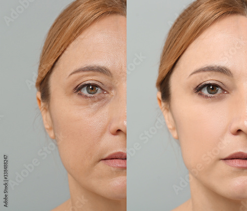 Woman before and after plas...