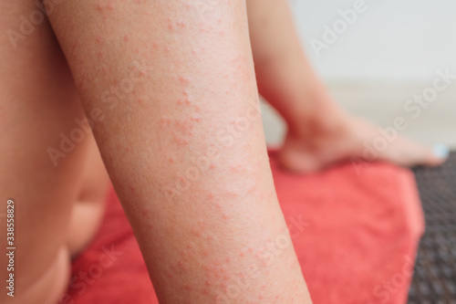 Dermatitis Herpetiformis skin rash in a woman with Nonceliac Gluten Sensitivity. Serum antibodies positive to wheat and gluten. Colonoscopy and upper endoscopy negative for celiac disease. photo