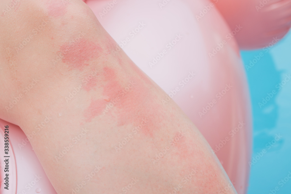 gluten rash