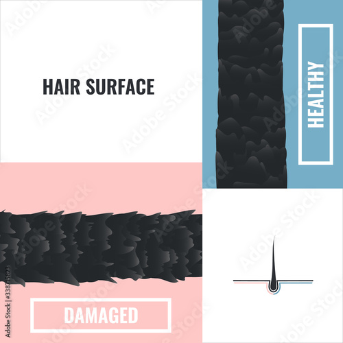 Hair surface of a damaged and healthy hair follicle under the microscope. Good and bad cuticle condition closeup. Trichology medical concept. Vector illustration.
