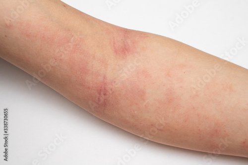 Woman's hand itchy red skin and atopic eczema is on the white background close up