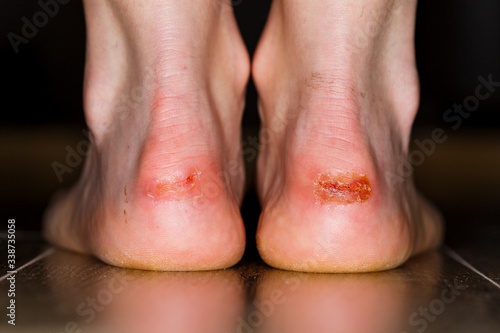 Painful injury on heel