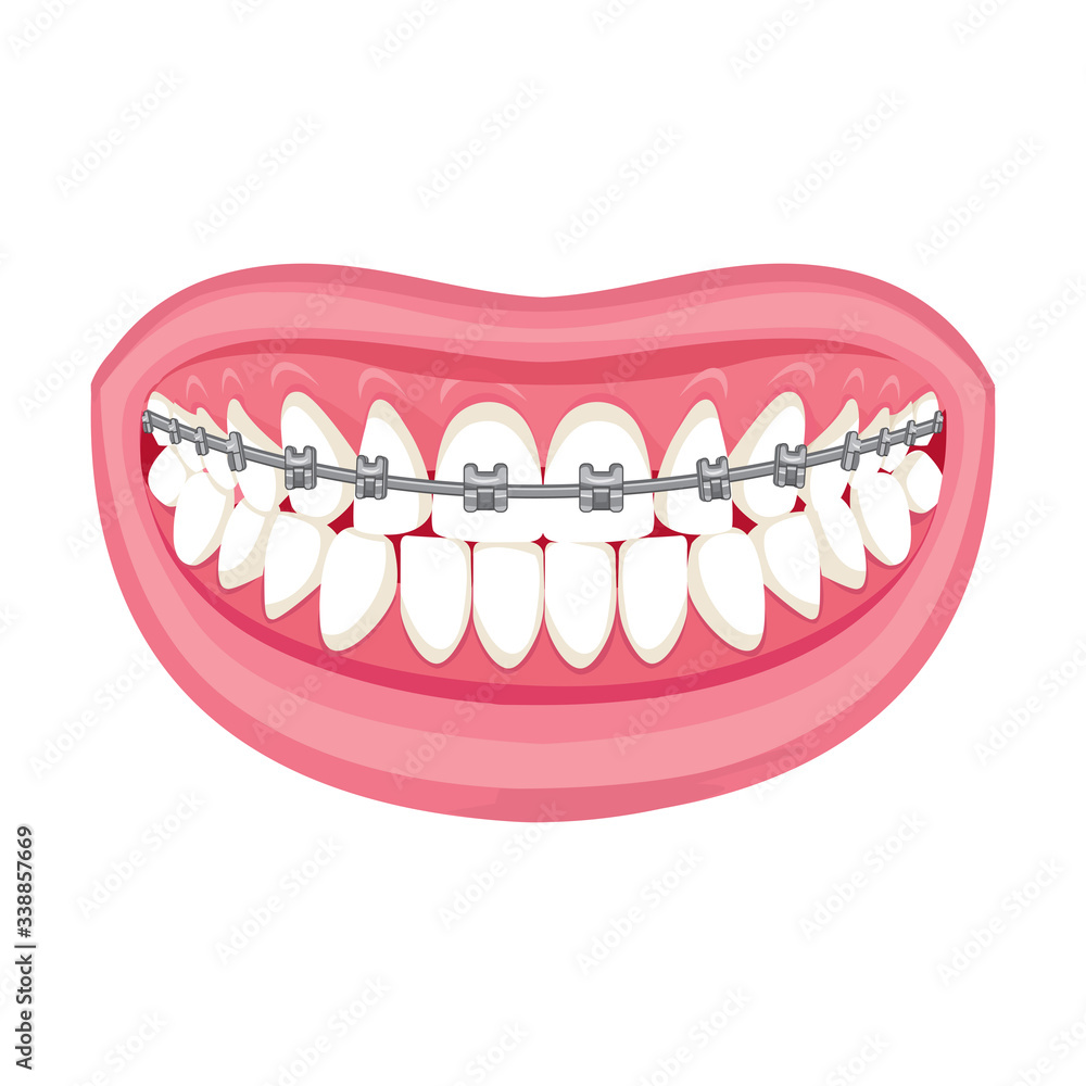 Braces on teeth. pink lips white teeth. White background. Braces on teeth. pink lips white teeth. White background.