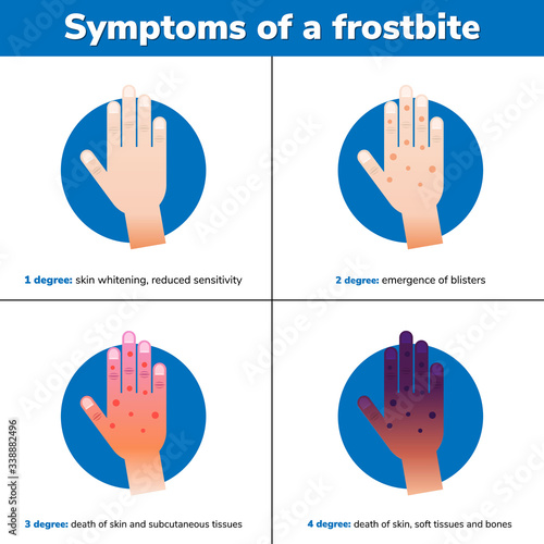 Simptoms of a frostbite. 4 medical stages. Infographic.