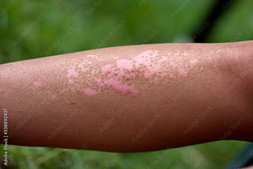 Vitiligo Vitiligo