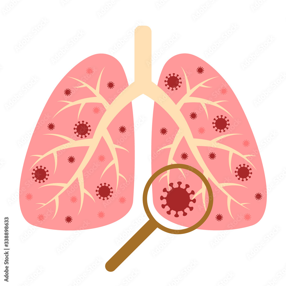 Corona virus design with disease lungs and virus. Coronavirus disease spread, symptoms. Respiratory system, infected man. Vector flat illustration Corona virus design with disease lungs and virus. Coronavirus disease spread, symptoms. Respiratory system, infected man. Vector flat illustration