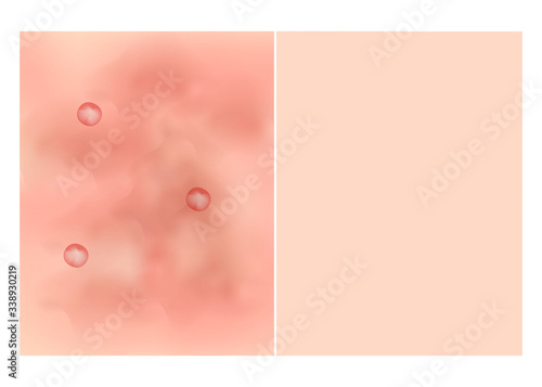 Texture, inflamed pimples and acne. Before After acne cysts. Skin background. Infographics. Vector illustration on isolated background.