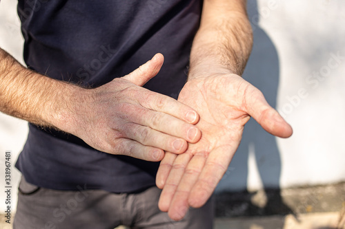 Very dry hands touching, peel due to washing alcohol on Covid19 situation. Horizontal close up of the inside and outside of a very dry cracked male hands. Outside on the street with sunshine