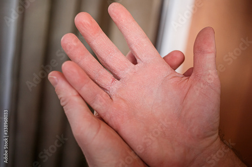 Very dry hands touching, peel due to washing alcohol on Covid19 situation. Horizontal close up of the inside of a very sore dry cracked male hand with flakey skin