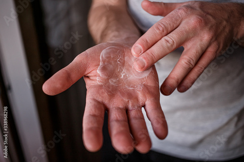 Man putting moisturizer onto his hand with very dry skin and deep cracks with cream due to washing alcohol on Covid19 situation. Horizontal close up of the inside of a very sore dry cracked male hand