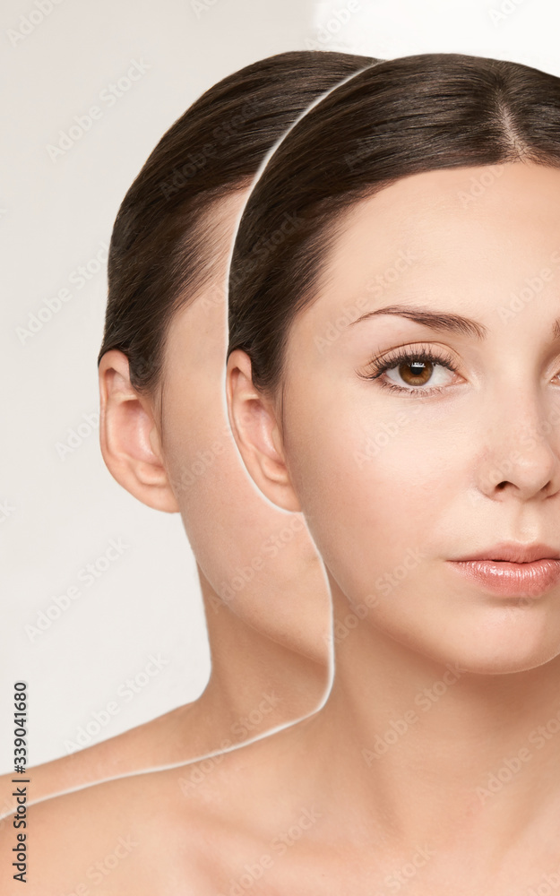 Pretty young girl. Before and after portrait. Aesthetic therapy. Big ear results. Cosmetology rejuvenation. Beauty model. Treatment procedure result. Pretty young girl. Before and after portrait. Aesthetic therapy. Big ear results. Cosmetology rejuvenation. Beauty model. Treatment procedure result.