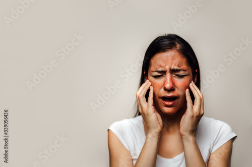 Woman with painful hot sunburn,facial skin redness problem,photosensitivity.Chemical burn,allergic reaction.Rosacea,dermatological condition,eczema.Tanning damage,sun protection.Suntan irritation.Rash