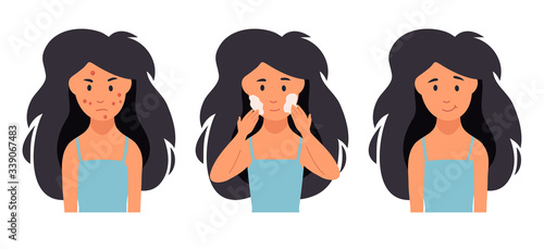 Acne treatment. Unhappy girl struggling with acne,pimples.