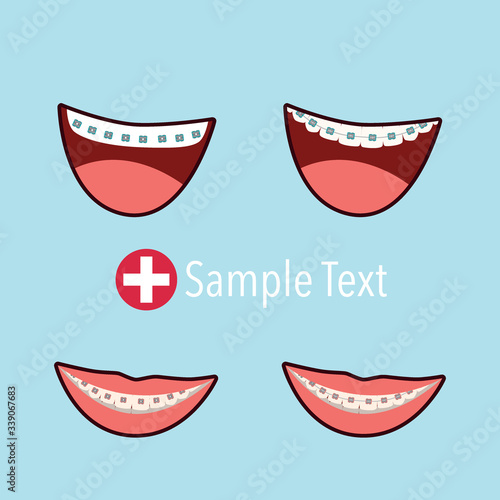 Tooth with metal braces or bracket system. Tooth Cure Orthodontics. Vector Illustration.