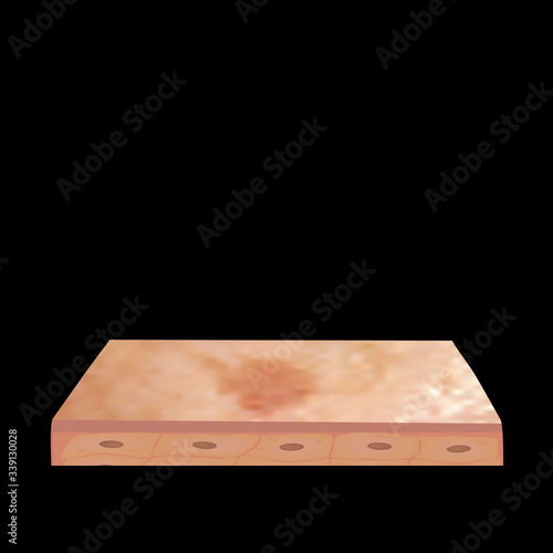 Pigmentation on the skin. Brown spots on the skin. Pigmentation treatment. Infographics. Vector