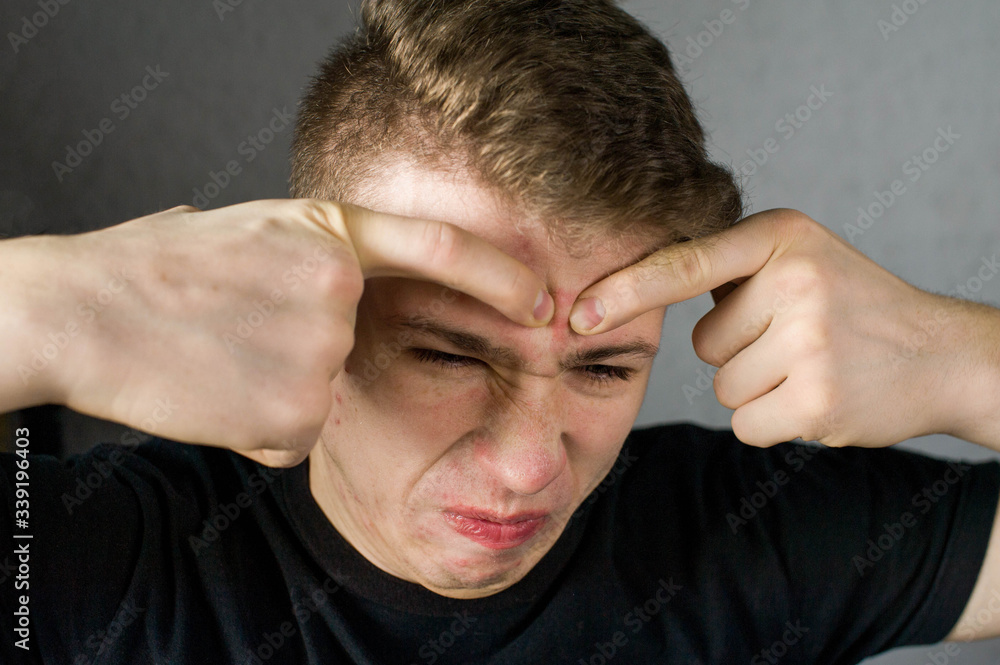 Young man struggling with acne on his face caring for his skin pushes acne presses a pimple on the forehead and contorts the face Young man struggling with acne on his face caring for his skin pushes acne presses a pimple on the forehead and contorts the face