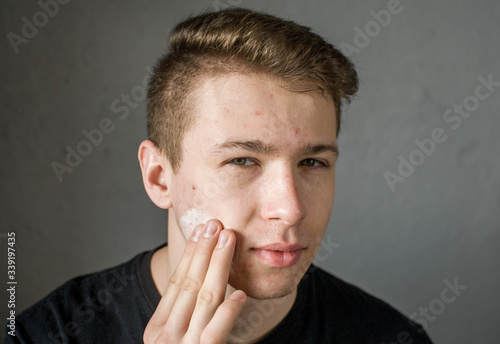 Young man struggling with acne on his face caring for his skin pushes acne applies a moisturizing cream mask of white color to the face