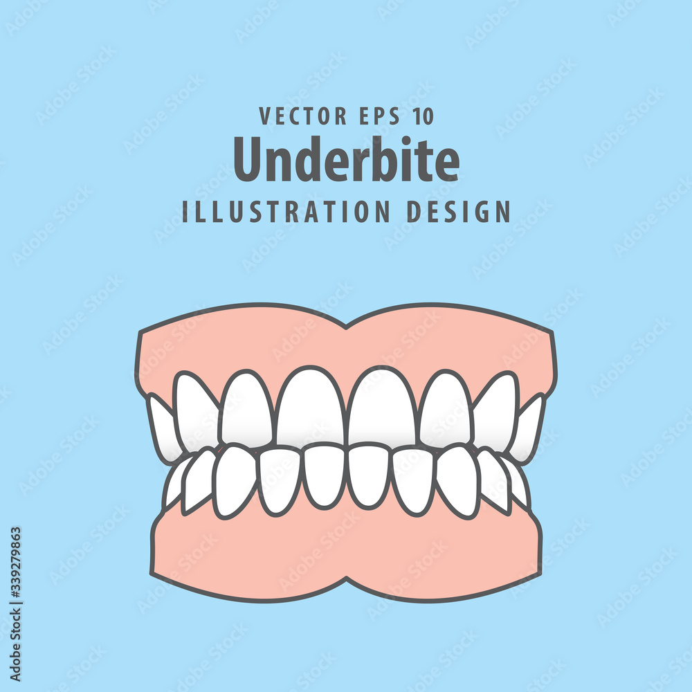 Dental underbite teeth illustration vector design on blue background. Dental care concept. Dental underbite teeth illustration vector design on blue background. Dental care concept.