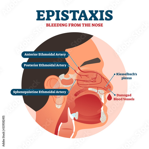 Epistaxis vector illustration. Bleeding from nose explanation health scheme