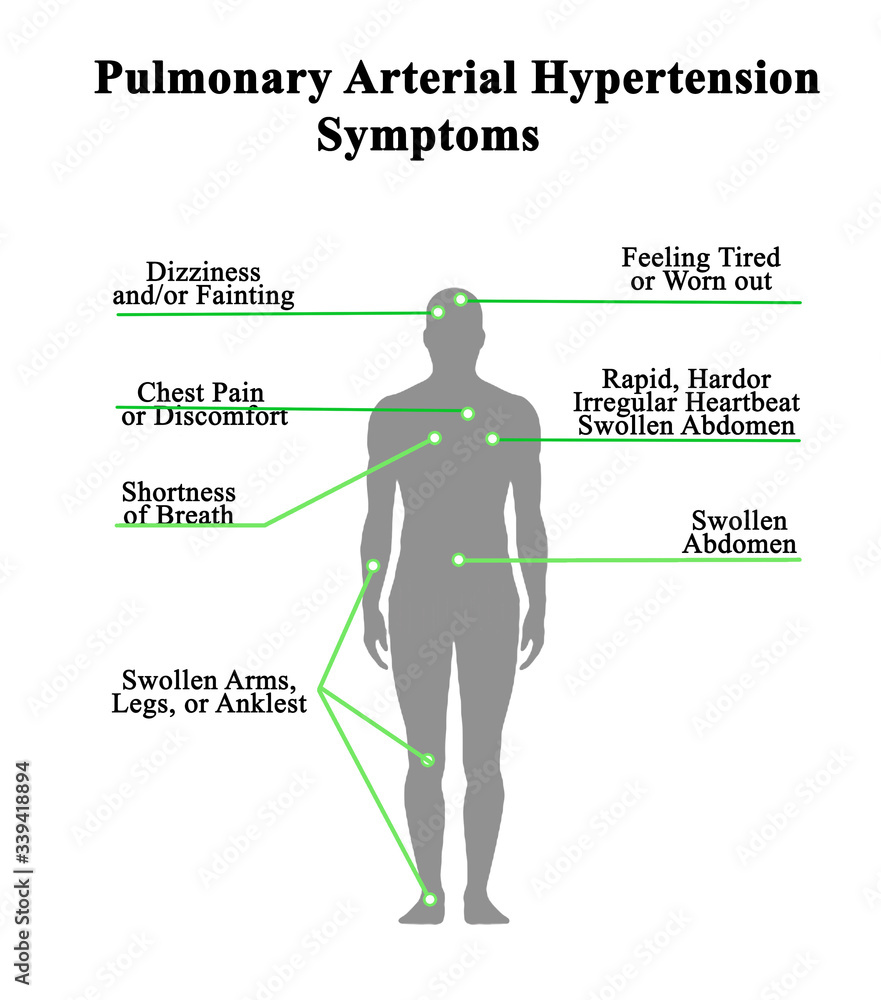 Seven Pulmonary Arterial Hypertension Symptoms