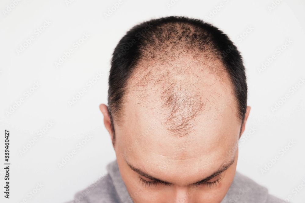 Male pattern hair loss problem concept. Young man losing hair on temples, close up. Space for text. Baldness, alopecia in males. Male pattern hair loss problem concept. Young man losing hair on temples, close up. Space for text. Baldness, alopecia in males.