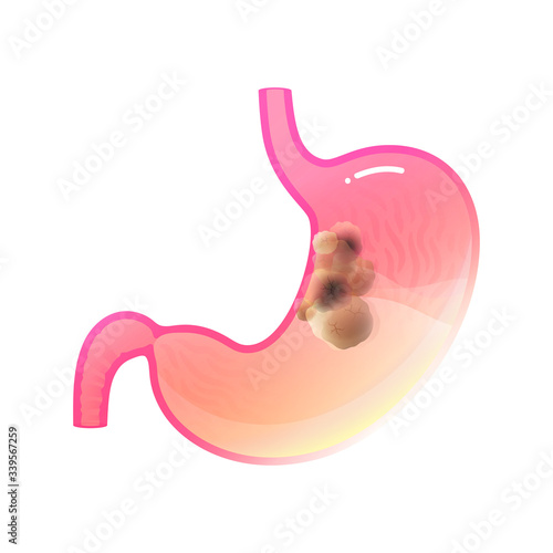 Vector isolated illustration of stomach cancer 