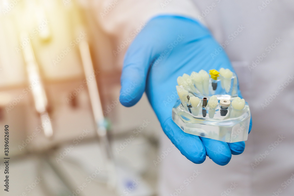dental implant concept. dentist holds a model of human jar with a teeth implants. dental implant concept. dentist holds a model of human jar with a teeth implants.