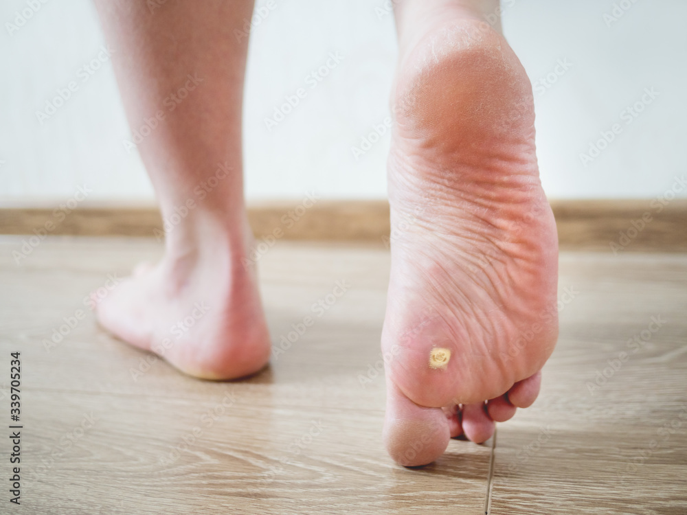 Fotografia do Stock Close up photo of plantar wart on man's foot