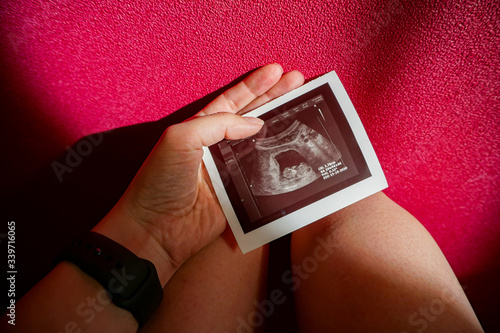 pelvic screening ultrasound, pregnancy 10 11 weeks, photo of the embryo on the lap of a girl on a pink background, miscarriage                              