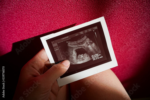 pelvic screening ultrasound, pregnancy 10 11 weeks, photo of the embryo on the lap of a woman on a pink background,  waiting for a girl       