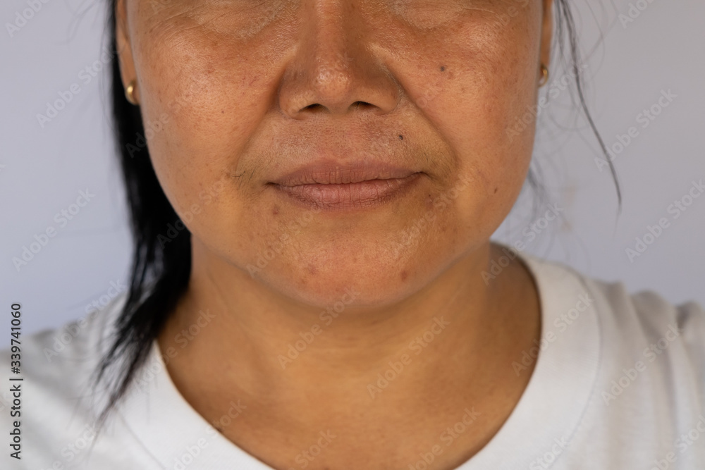 Fototapeta premium An Asian woman with the Nasolabial folds (cheeks lines) and skin problem such as wrinkles and dark spots on her face.