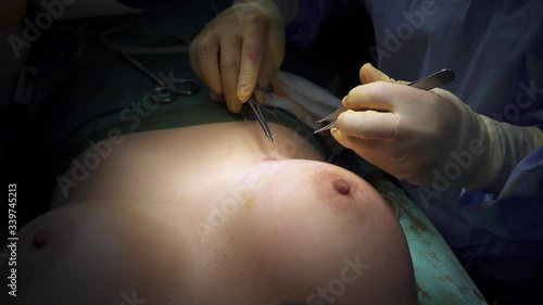 Crop surgeon stitching incision after mammoplasty photo