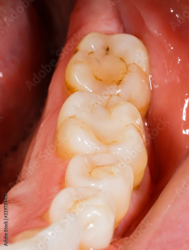 human teeth before dental treatment