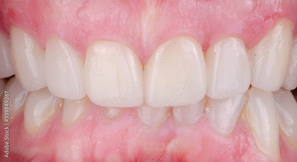 The ceramic dental veneer and healthy gum