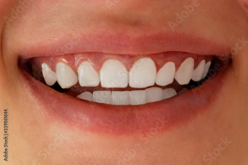 White teeth close-up. Dental whitening.