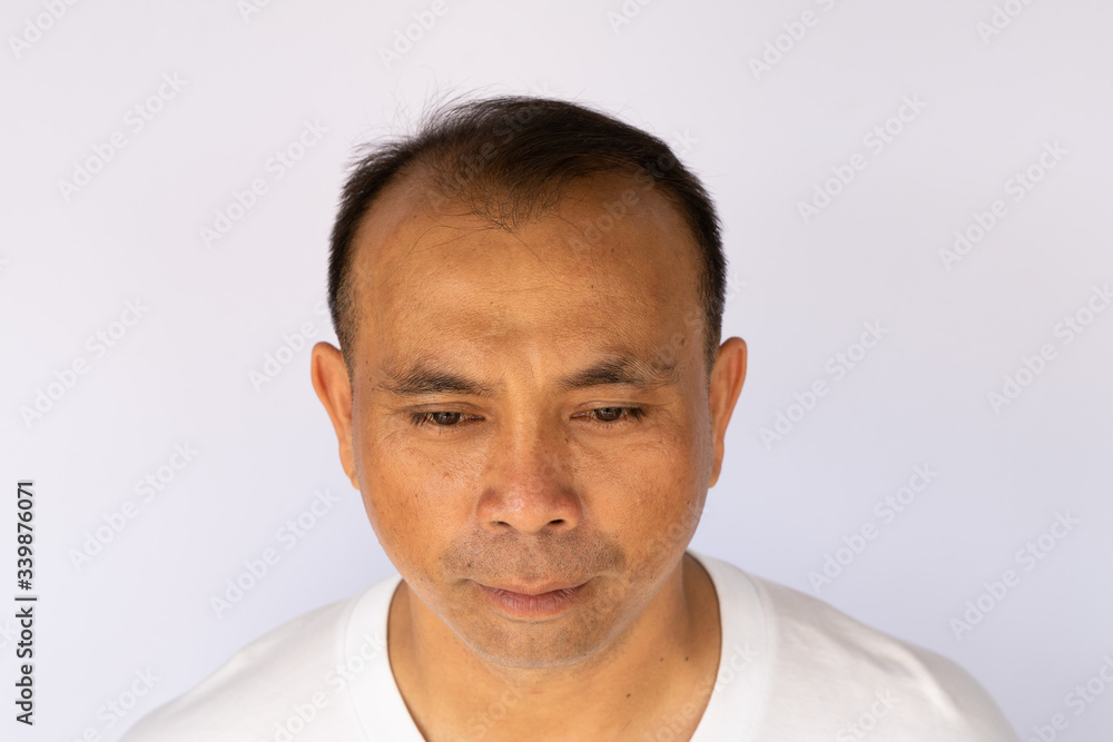 Obraz premium An Asian man with hair loss