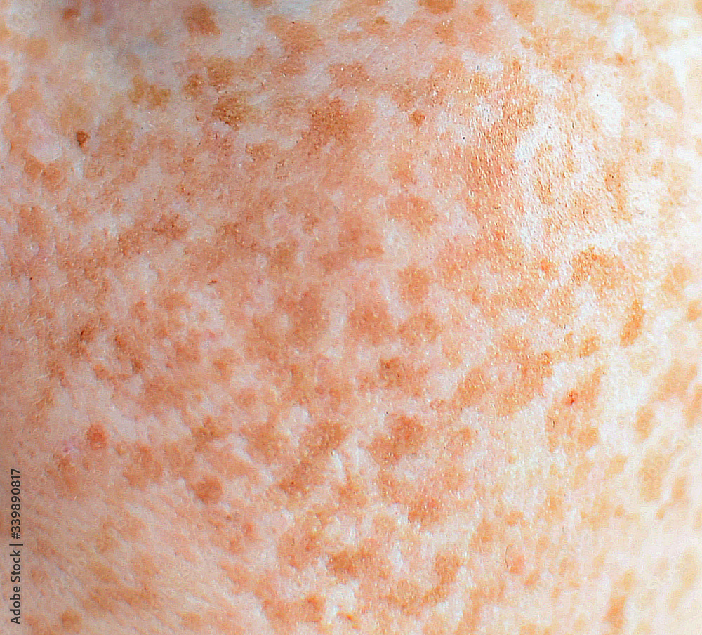 skin with freckles, close-up, macro