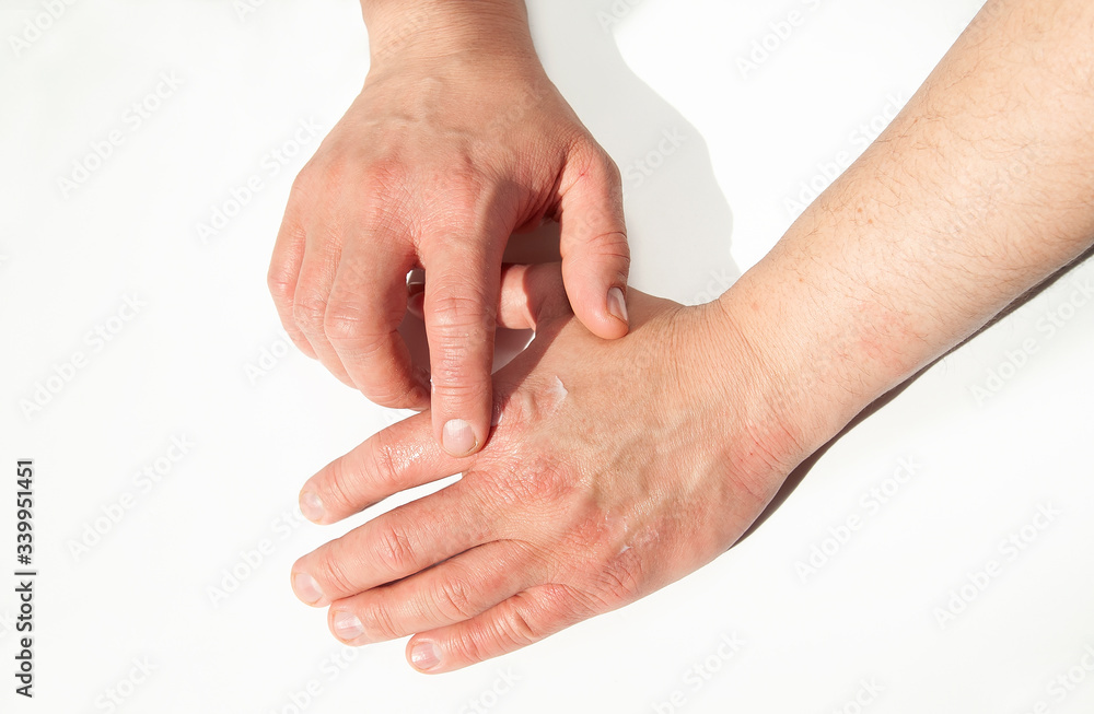 Fototapeta premium to smear hands with a cream from dermatitis and reactions to allergies. Minor abrasions and wounds on men's hands