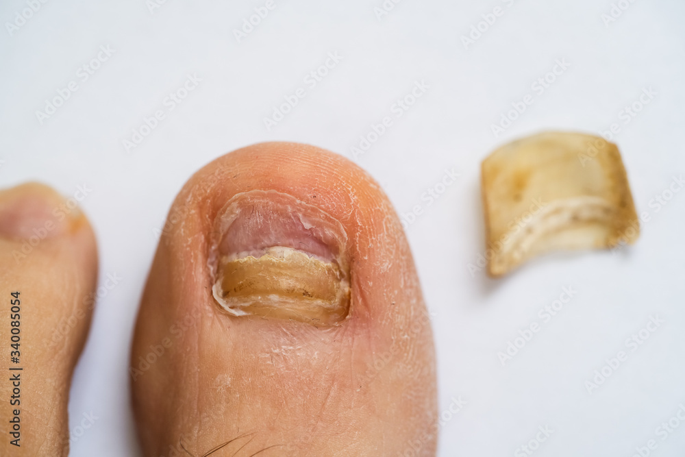 Broken Foot Nail And Fungal Infection Broken Foot Nail And Fungal Infection
